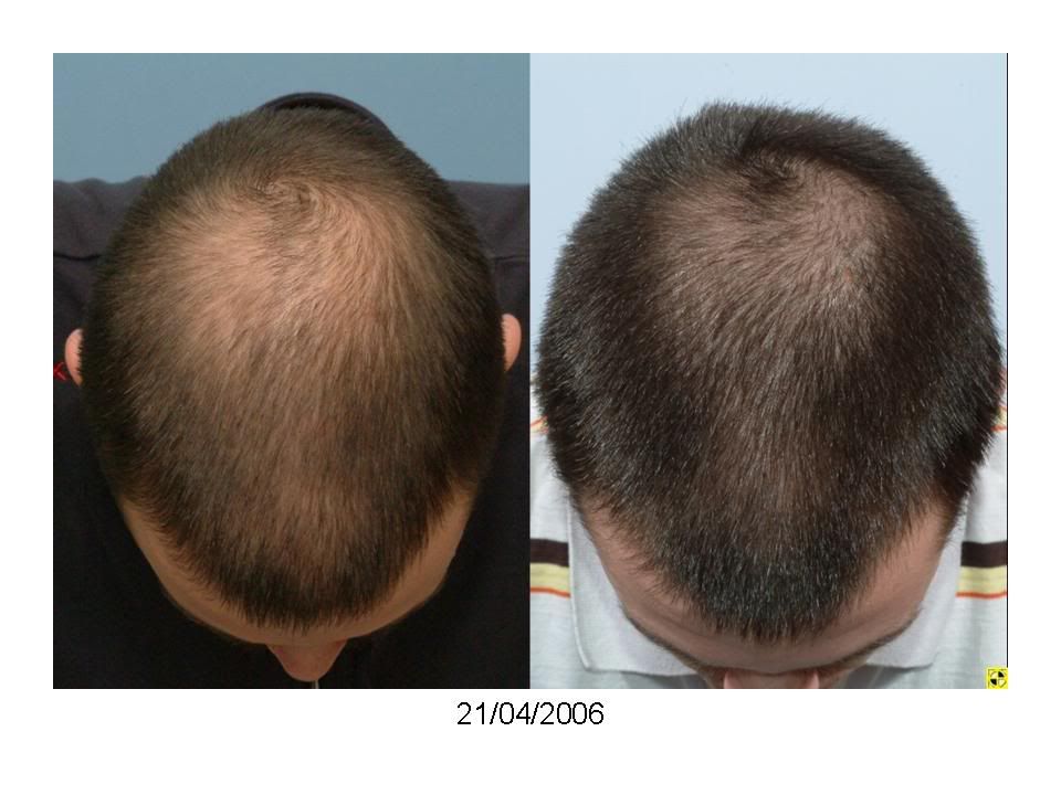 Positive results with finasteride